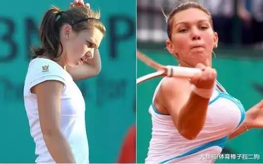 运动员缩胸,网球女运动员缩胸手术