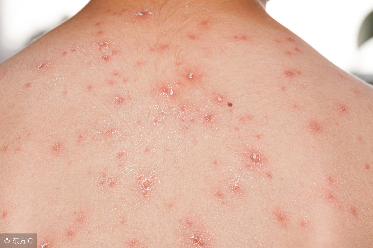 水痘患儿常见的并发症是,儿童患水痘的护理方法