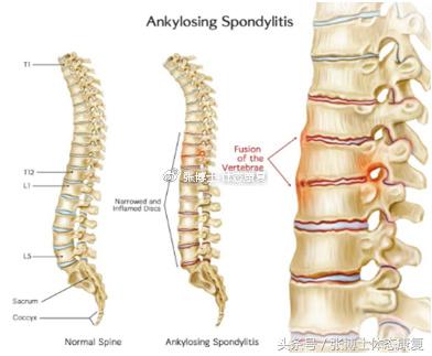 强直性脊柱炎髋关节粘连康复训练,运动疗法强直性脊柱炎研究现状