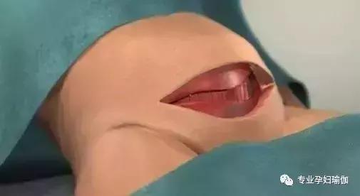 剖腹产有什么并发症吗,剖腹产后遗症要重视吗