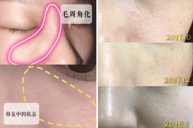 小颗粒是痘痘吗,怎么区分是闭口粉刺还是毛周角化