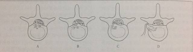 点穴疗法治腰椎间盘突出立竿见影,麦肯基腰椎间盘突出七步疗法图解