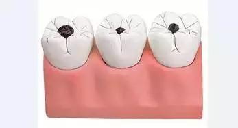 牙齿上有黑色的线怎么预防,如果牙齿上有小黑线要重视