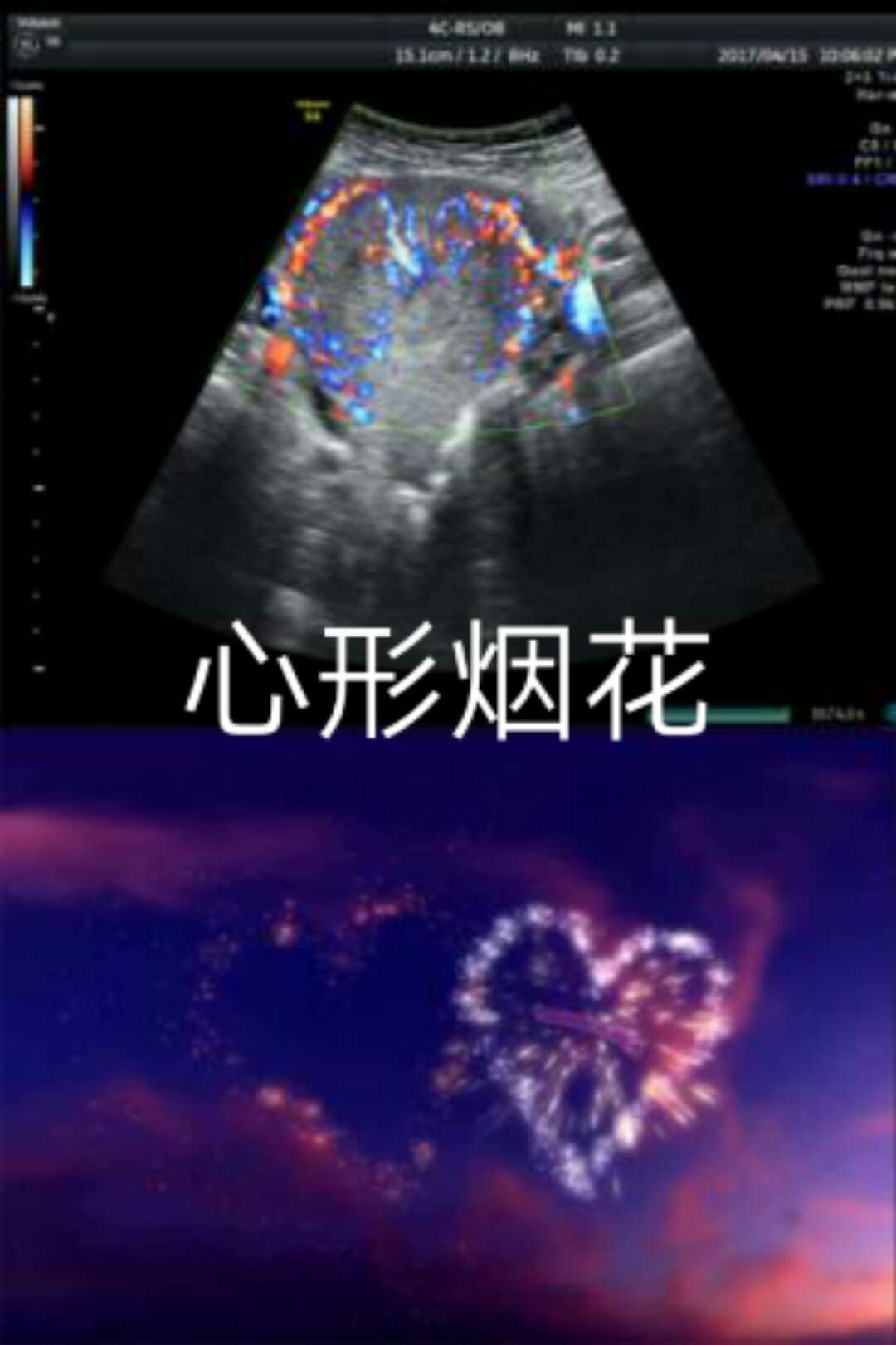 顺产的子宫为什么要流血,顺产后子宫有血怎么办