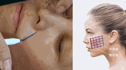 埋线提升多久能恢复好,真相来了拉皮手术潜在的风险