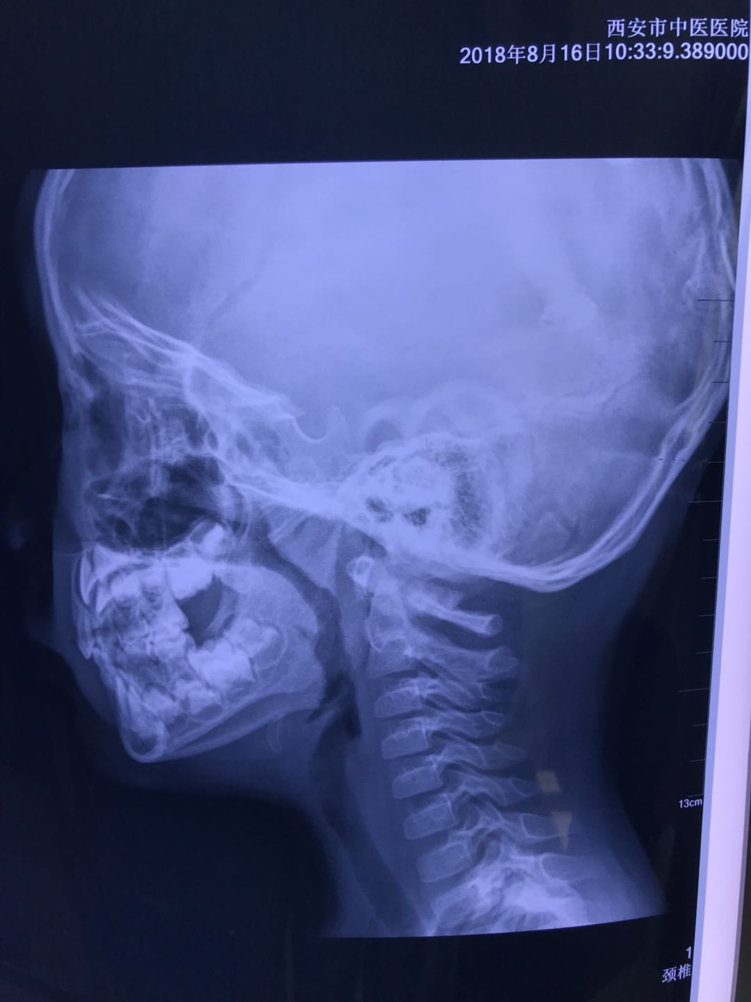 刘鉴医案：刘医生，我女儿的腺样体好了