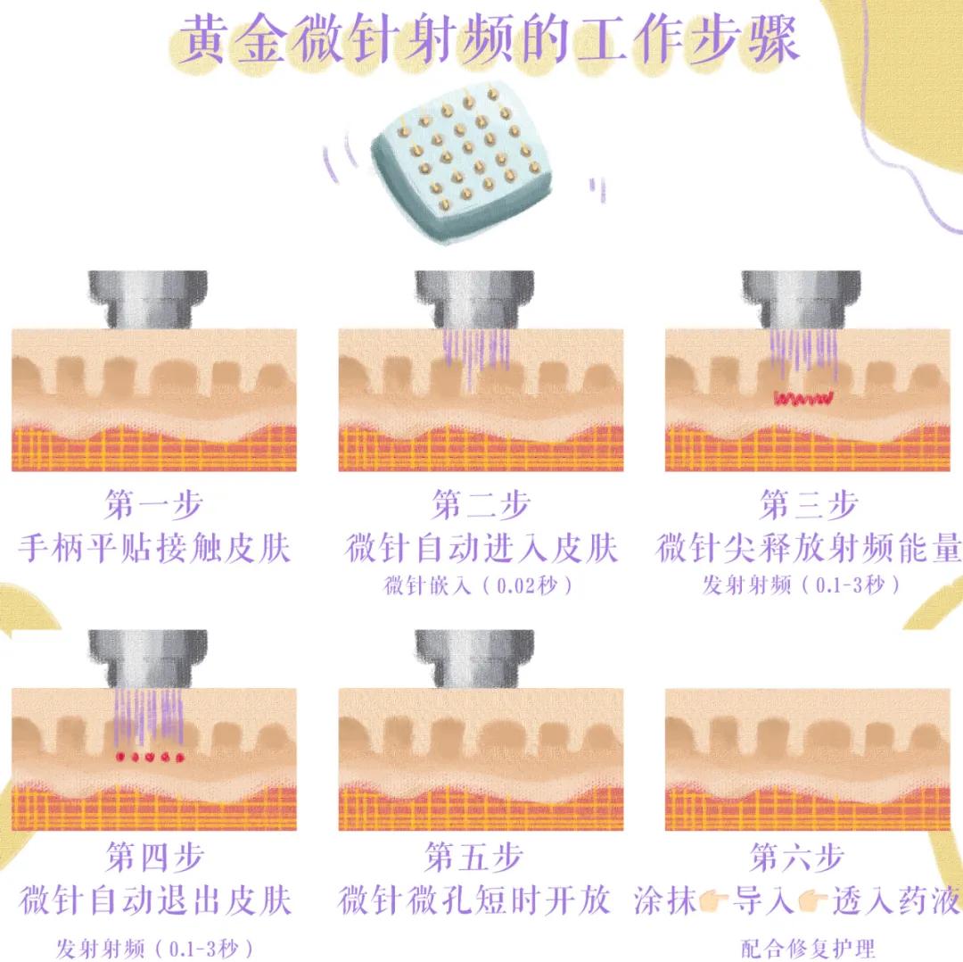 医美做什么能永远不长痘,脸很多痘坑做什么医美