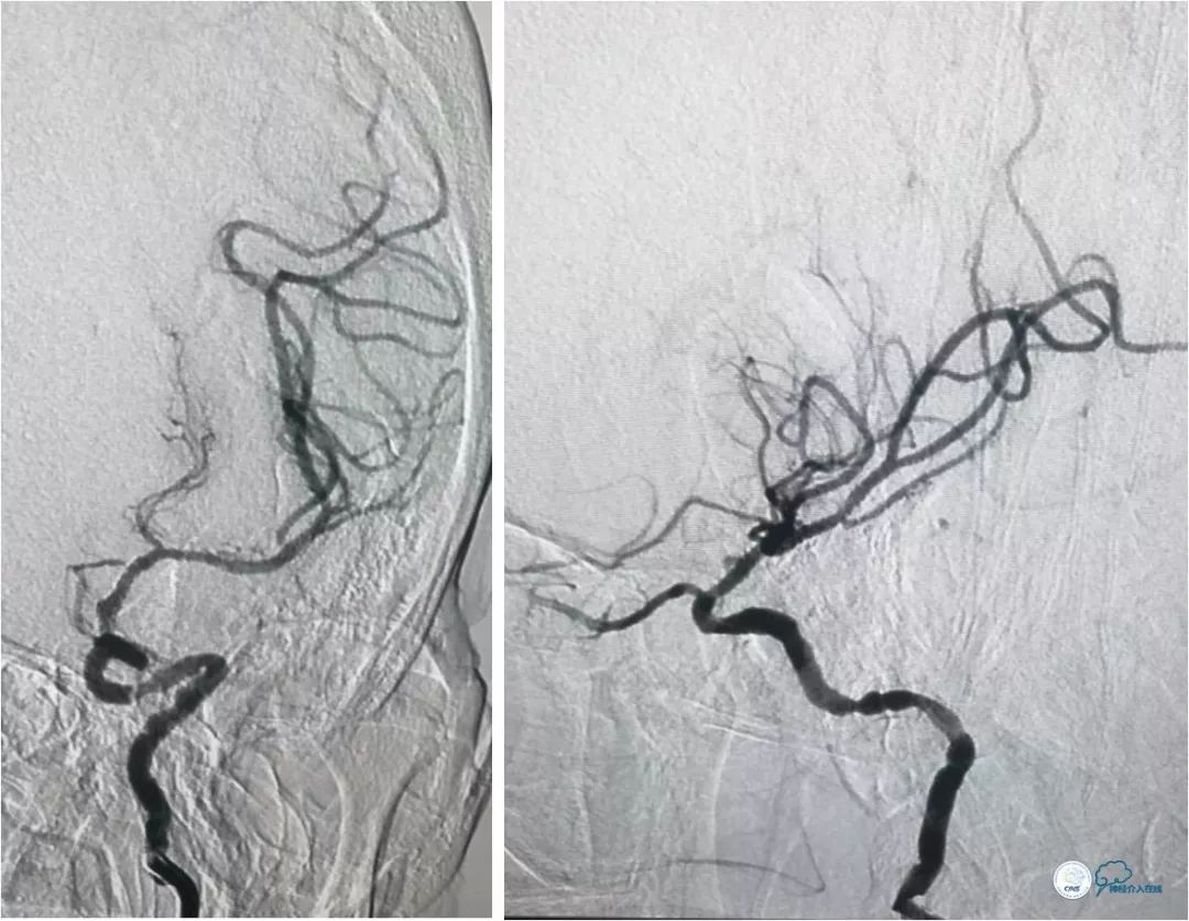 天坛医院住院日记,颈内动脉c5到c7段狭窄微创手术