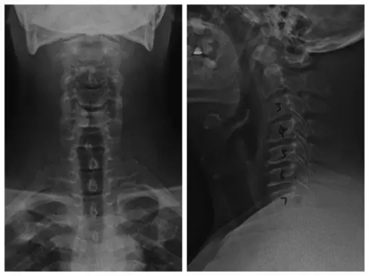 揭秘麦瑞科技内涵:老知青的颈椎术后恢复神速的原因找到了!