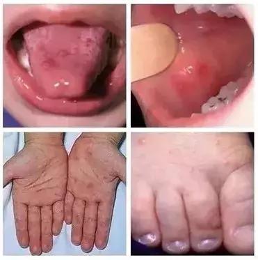 手足口病来袭如何护孩子周全,新型手足口和普通手足口