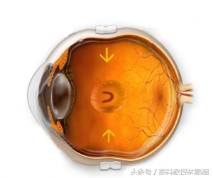 眼睛有飞蚊会导致视网膜脱落吗,有飞蚊症还闪光是视网膜脱落吗