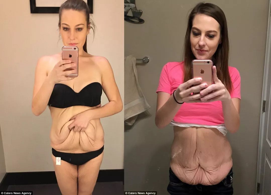 瘦了200斤，身体很多赘皮，怎么办？