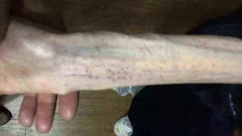 21岁女孩自杀式减肥只剩50斤，差点变成植物人！照片不忍直视