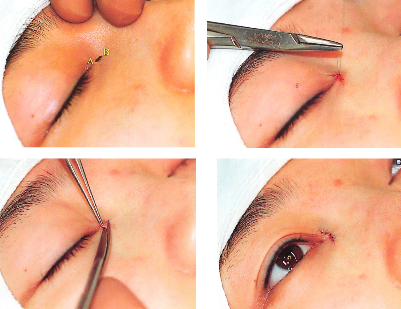 内眦赘皮要去整形医院吗,内眦赘皮怎么整形