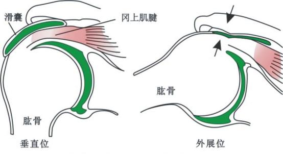 得了肩峰撞击症如何康复,肩峰撞击症是怎么回事