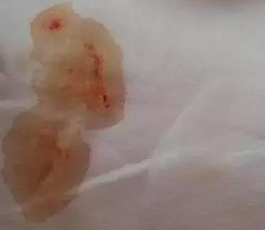 刚出生女宝宝尿布上有血啥原因,女婴尿布上有血迹家长没有在意