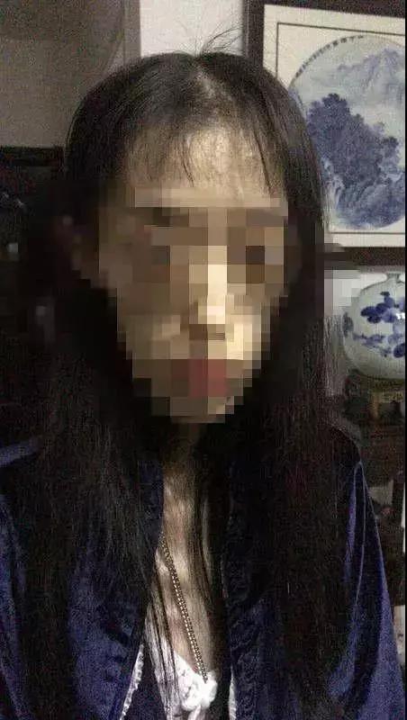 21岁女孩自杀式减肥只剩50斤，照片不忍直视