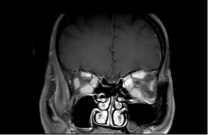 甲状腺相关眼病的科普,甲状腺眼病的临床表现