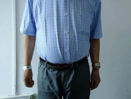 天呐！大伯吃掉上百支治皮炎的软膏，医生一问都懵了