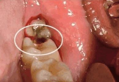 虫牙是虫子引起的吗,虫牙真的是被虫子吃掉的吗