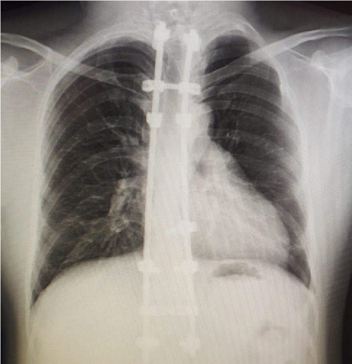 脊柱侧弯手术后肋骨外翻,脊柱侧弯做手术后续