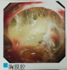 胸水抽了为什么还呼吸困难,胸水抽不出来了怎么回事