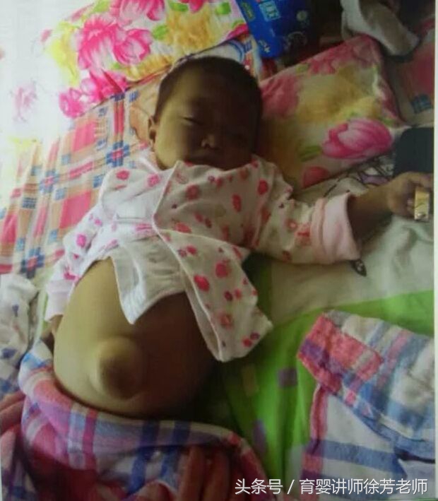 肚脐眼总鼓起来，这样的情况需要去医院，详细原因处理都在了