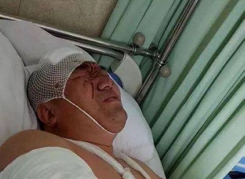 头部外伤容易恢复吗,头部受伤要不要去医院