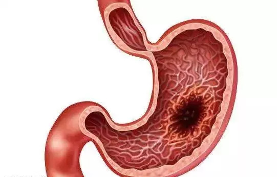 吃辣容易致癌吗,爱吃辣增加健康风险吗