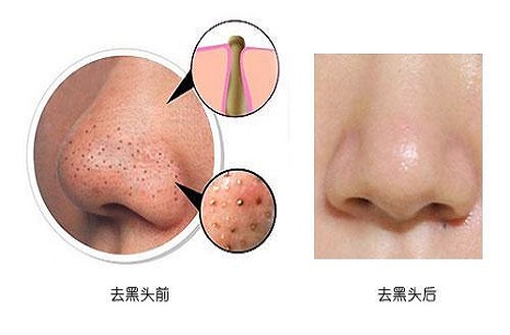 脸部黑头严重还掉皮怎么办,脸部有一个黑头去不干净什么原因