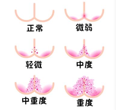 宝宝红屁股尿布疹了怎么办,尿布疹红屁股用什么药