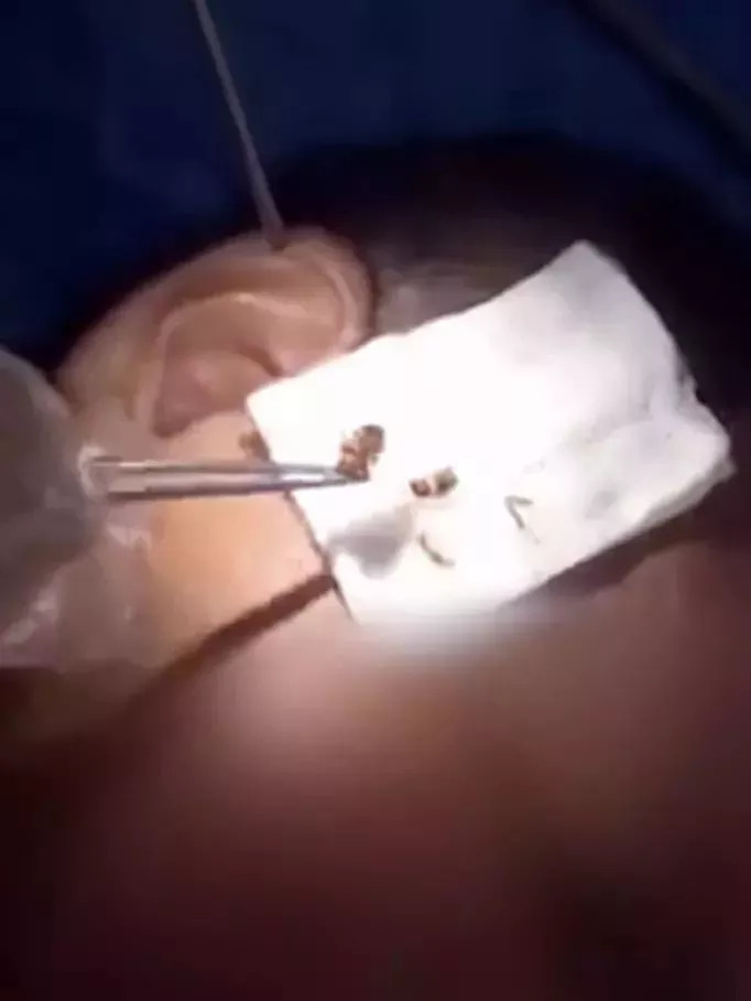 女子发烧40度罪魁祸首,女孩反复发烧四年才找到幕后元凶