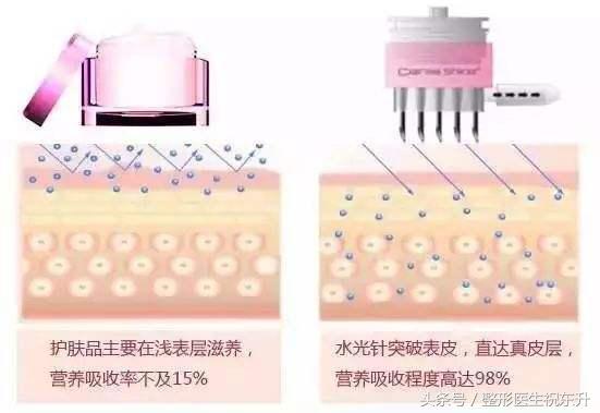 水光针打几针能改善毛孔,水光针打一次效果图