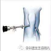 最新的人工膝关节使用寿命,膝关节使用说明