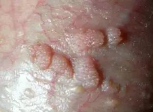 预防宫颈癌要打针,宫颈癌筛查52阳性可以打hpv疫苗吗