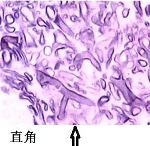看懂痰涂片的真菌结果就这么简单！