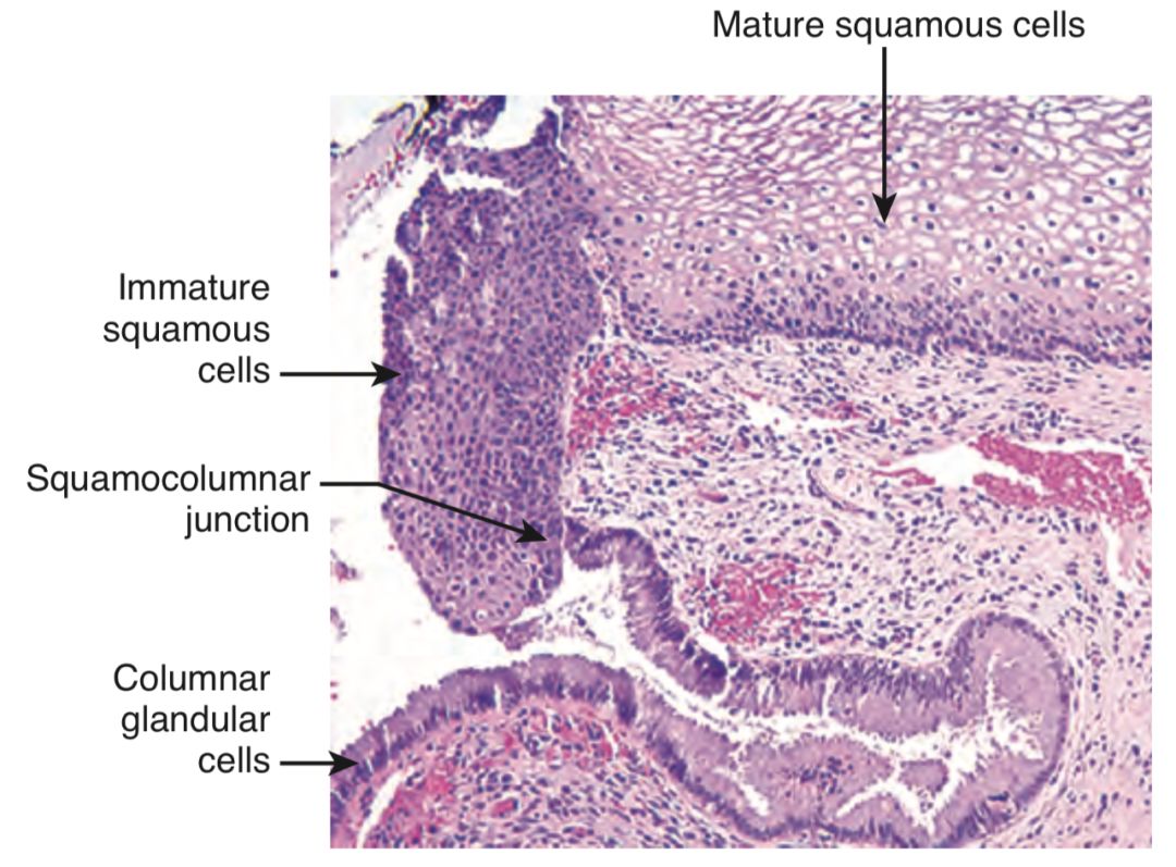 宫颈癌筛查1000多,宫颈癌筛查推介会