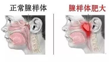 小孩子讲话出现鼻音，可能是腺样体肥大