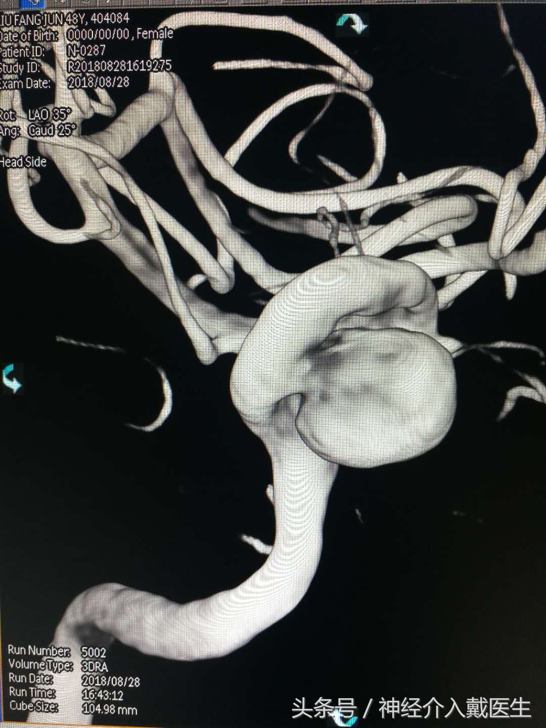 动脉瘤球囊辅助弹簧圈栓塞术,介入栓塞弹簧圈进口和国产区别