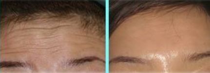 抬头纹多又深警惕心血管疾病,抬头纹特别深怎么办