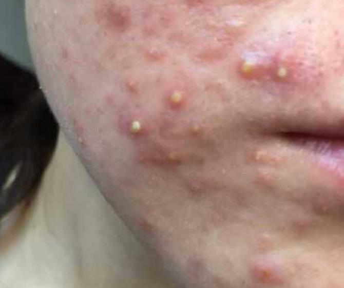 凉席螨虫咬人怎么去除,夏季凉席会造成螨虫过敏吗