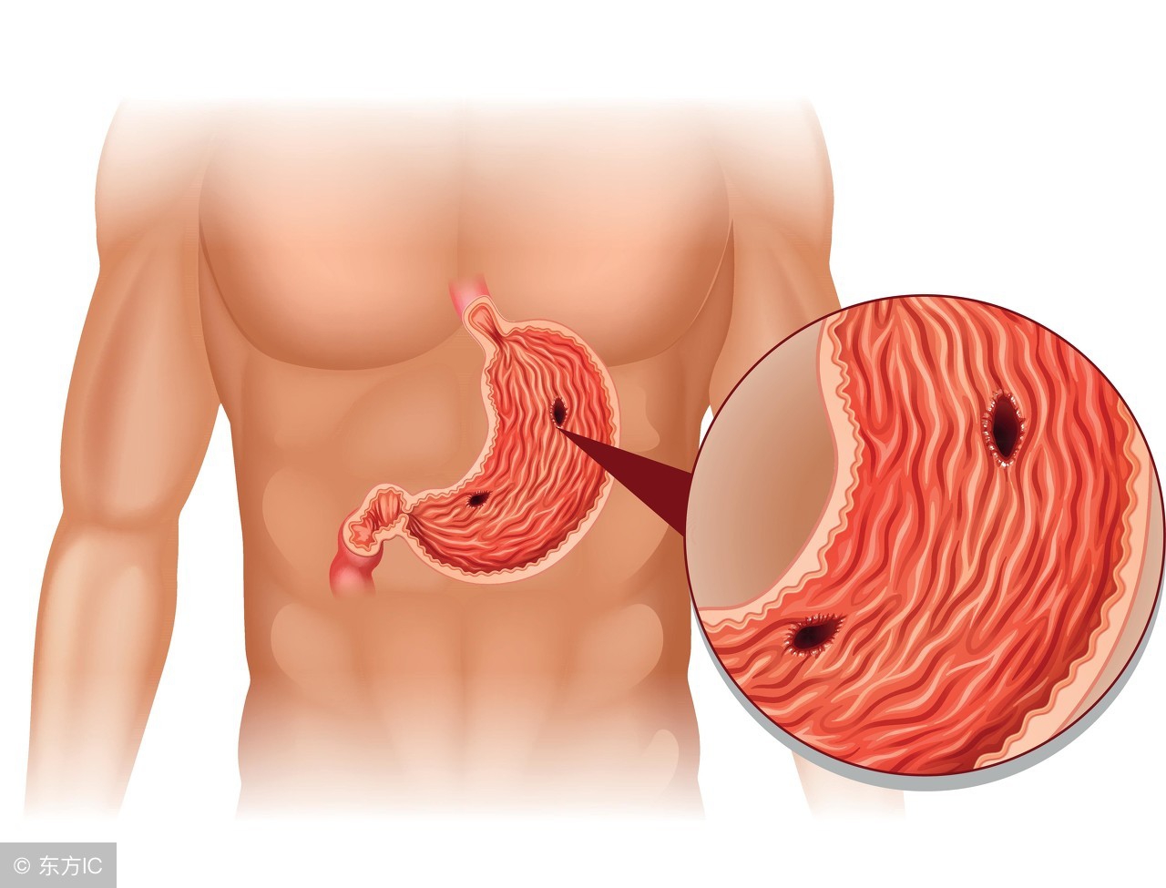 浅表性胃炎伴糜烂是糜烂性胃炎么,浅表性胃炎糜烂性胃炎可以根治吗