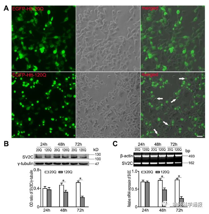“会跳舞的猪”：突变亨廷顿蛋白与亨廷顿病