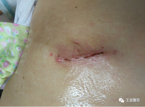 肋软骨隆鼻你要知道的,肋软骨隆鼻怎么样好得快