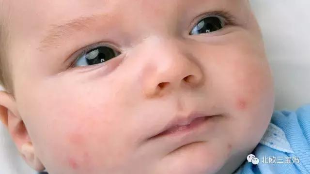 儿童急疹科普,宝宝湿疹和热疹的正确护理方法