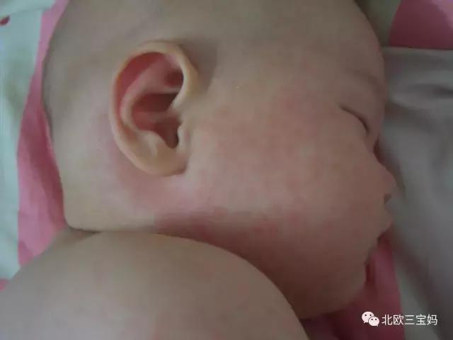 怎么分辨宝宝热疹湿疹荨麻疹,幼儿急疹和湿疹风疹有什么区别