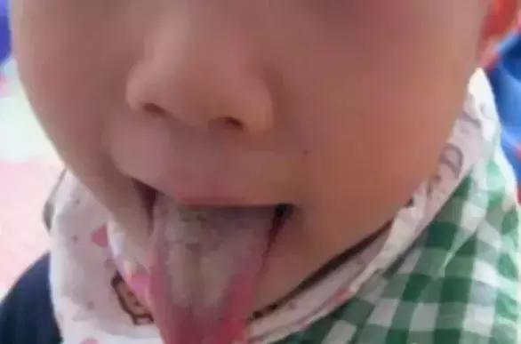 宝宝舌苔变化有什么症状,宝宝舌苔怎么样才是健康的
