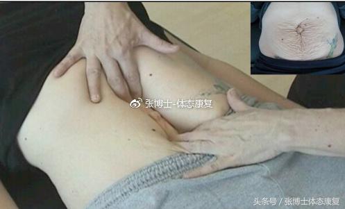 「运动康复科普」宝妈们看过来,产后腹直肌分离的康复训练