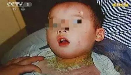 宝宝湿疹终于好了,宝宝湿疹治愈经历