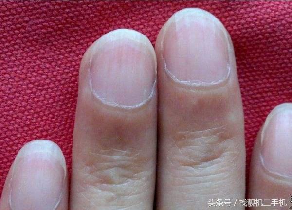 手指上没有月牙代表什么意思,十个手指都没有月牙这说明什么